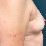 Breast Augmentation Before & After Patient #3930
