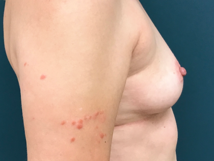 Breast Augmentation Before & After Patient #3930