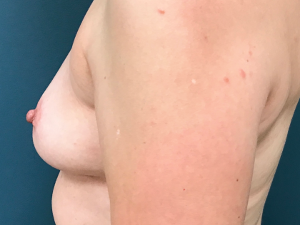 Breast Augmentation Before & After Patient #3930