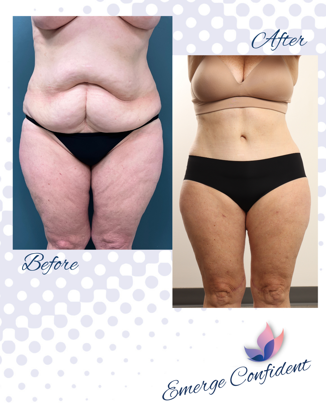 Weight Loss Loose Skin On Thighs Loose Skin Thighs After Weight