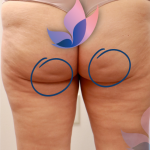 Avéli Before & After Patient #4003