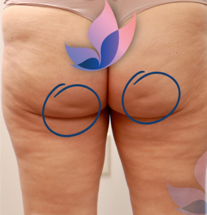 Avéli Before & After Patient #4003