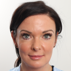 Blepharoplasty Before & After Patient #4006