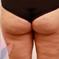 Avéli Before & After Patient #4003