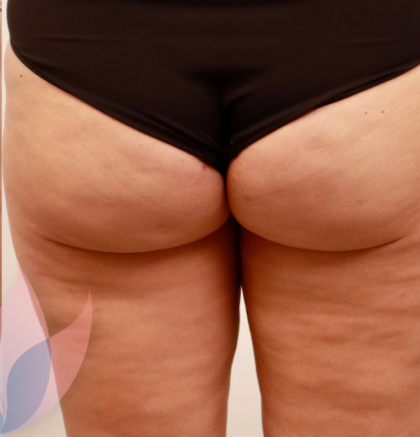 Avéli Before & After Patient #4003
