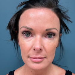 Blepharoplasty Before & After Patient #4006