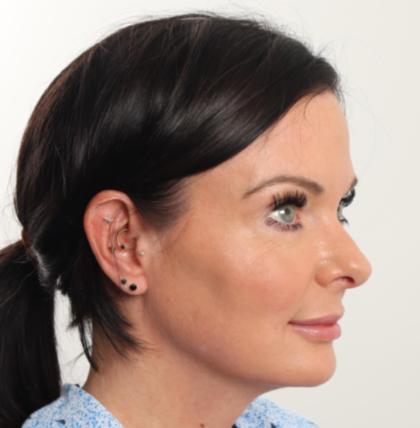 Blepharoplasty Before & After Patient #4006