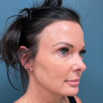 Blepharoplasty Before & After Patient #4006