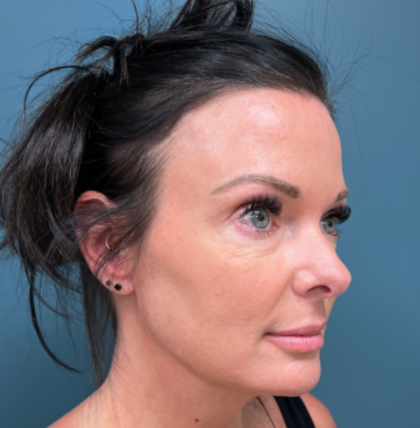 Blepharoplasty Before & After Patient #4006