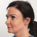 Blepharoplasty Before & After Patient #4006