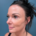 Blepharoplasty Before & After Patient #4006
