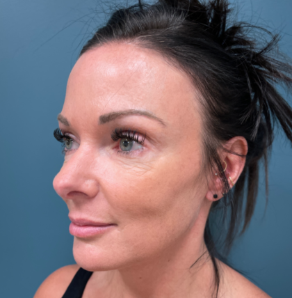 Blepharoplasty Before & After Patient #4006