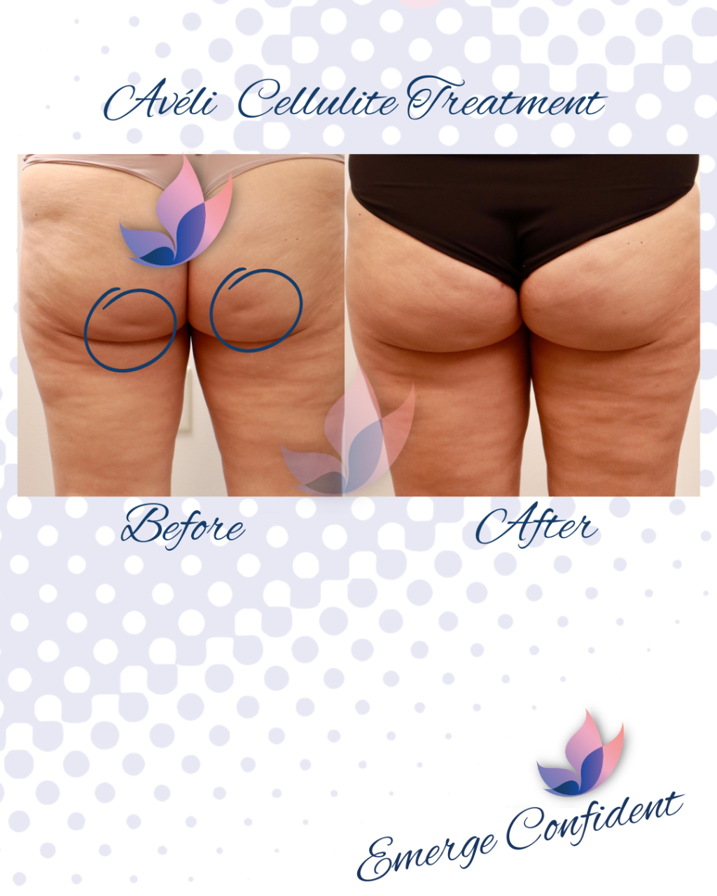 glutathione cellulite Cellulite – Epidermal Recovery Center main image 0