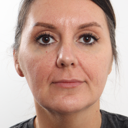 Facelift Before & After Patient #4077