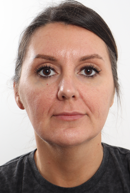 Facelift Before & After Patient #4077
