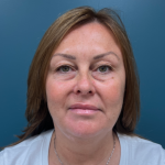 Blepharoplasty Before & After Patient #4062