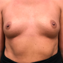 Breast Augmentation Before & After Patient #4088