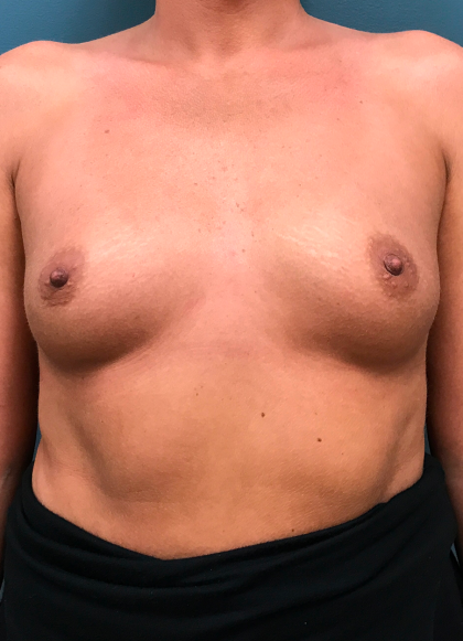 Breast Augmentation Before & After Patient #4088