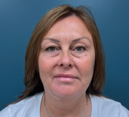 Blepharoplasty Before & After Patient #4062