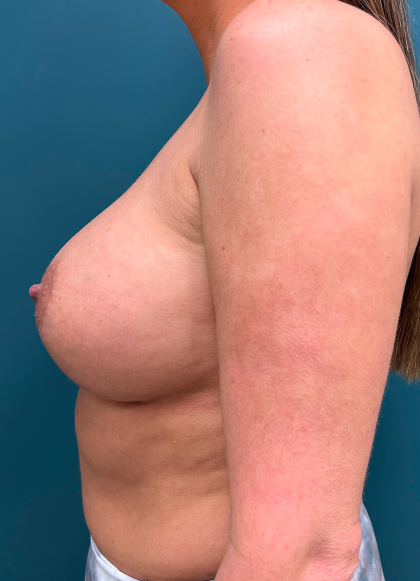 Breast Augmentation Before & After Patient #4088