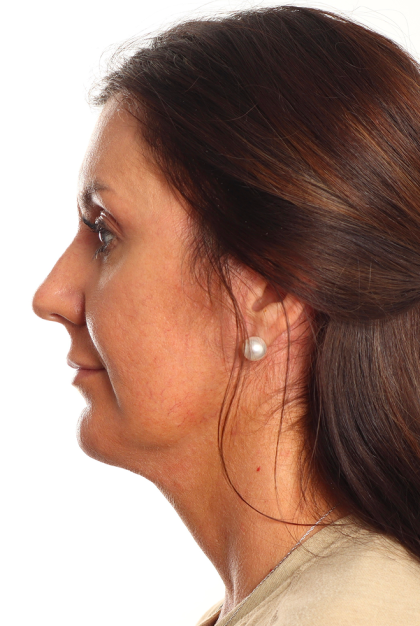 Facelift Before & After Patient #4077