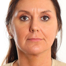 Facelift Before & After Patient #4077