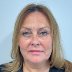 Blepharoplasty Before & After Patient #4062