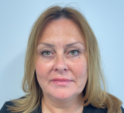 Blepharoplasty Before & After Patient #4062