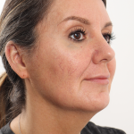 Facelift Before & After Patient #4077