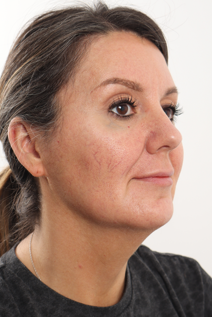 Facelift Before & After Patient #4077