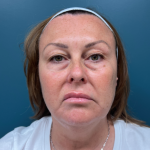 Blepharoplasty Before & After Patient #4062