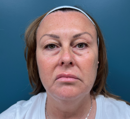 Blepharoplasty Before & After Patient #4062