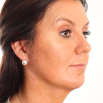 Facelift Before & After Patient #4077