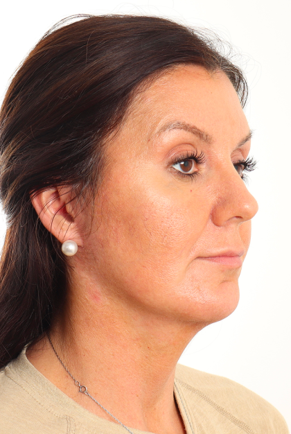 Facelift Before & After Patient #4077