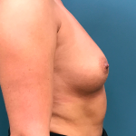 Breast Augmentation Before & After Patient #4088