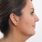 Facelift Before & After Patient #4077