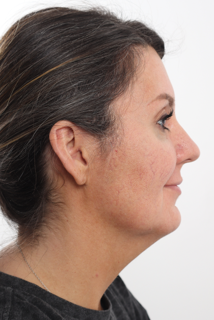 Facelift Before & After Patient #4077