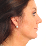 Facelift Before & After Patient #4077
