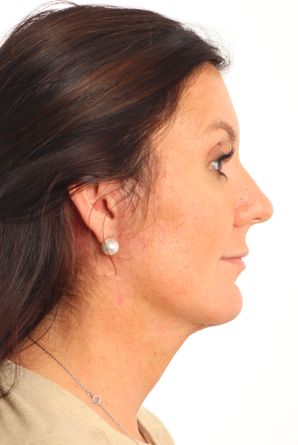 Facelift Before & After Patient #4077