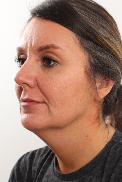 Facelift Before & After Patient #4077
