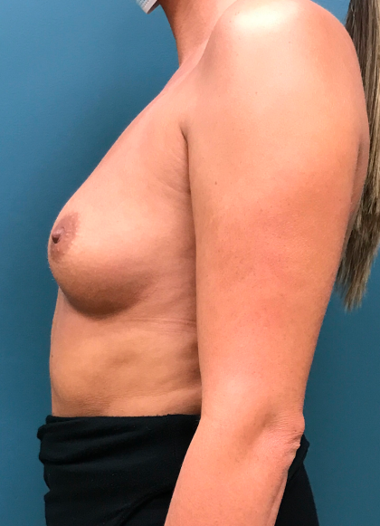 Breast Augmentation Before & After Patient #4088