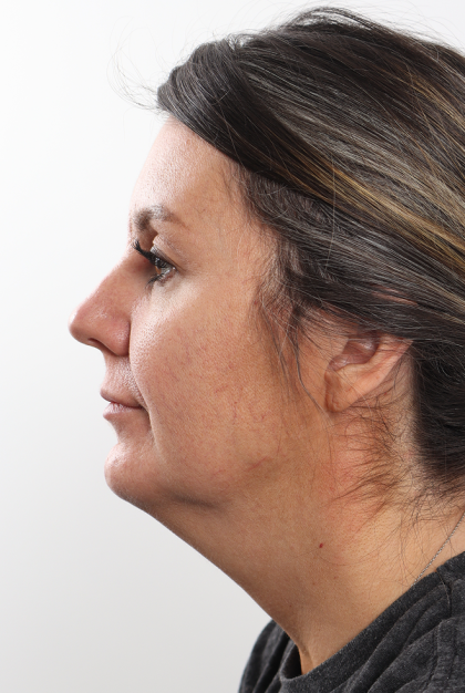 Facelift Before & After Patient #4077