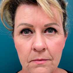 Facelift Before & After Patient #4110