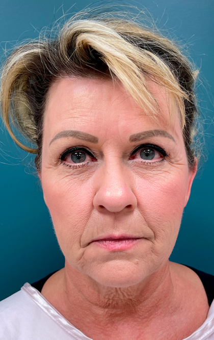 Facelift Before & After Patient #4110