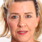 Facelift Before & After Patient #4110