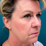Facelift Before & After Patient #4110
