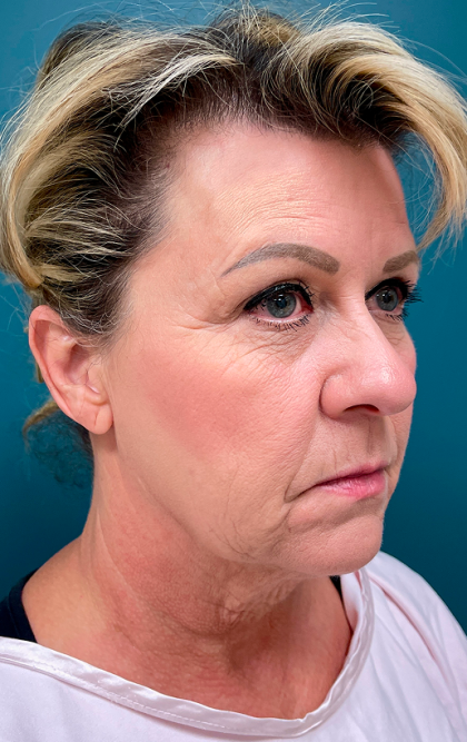 Facelift Before & After Patient #4110