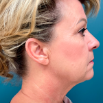 Facelift Before & After Patient #4110