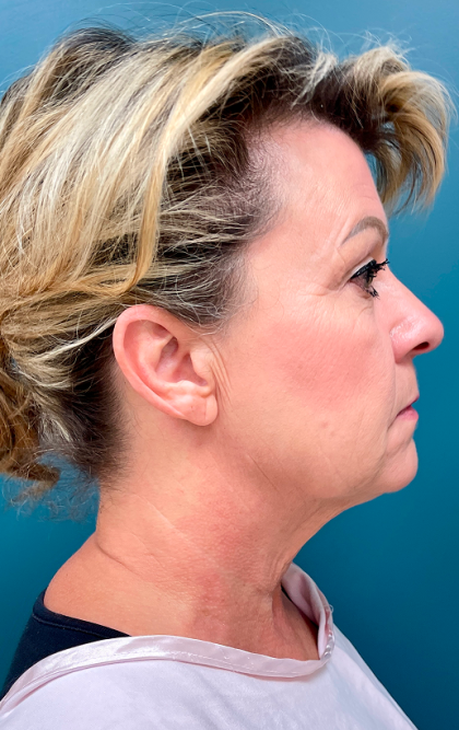 Facelift Before & After Patient #4110