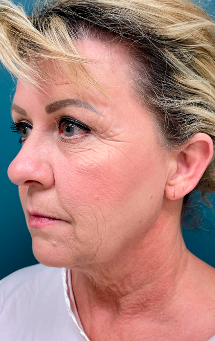 Facelift Before & After Patient #4110